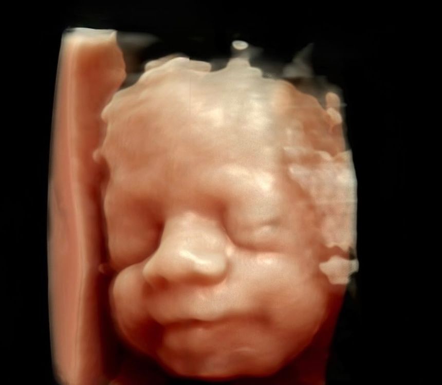 Üçüncü trimesterde 3 boyutlu ultrasonografi ile görüntülenen fetal yüz
